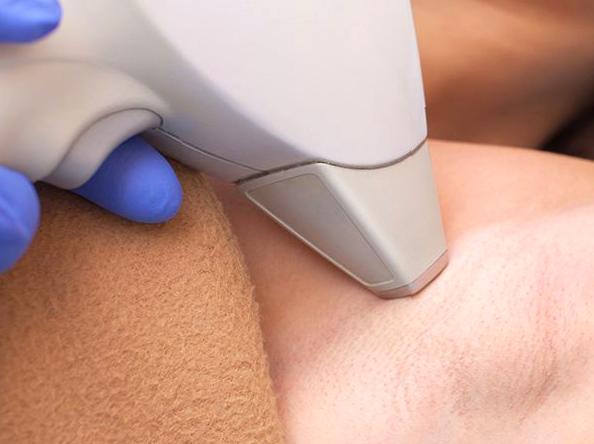 Laser Hair Removal: Choices and Success for Fair Hair