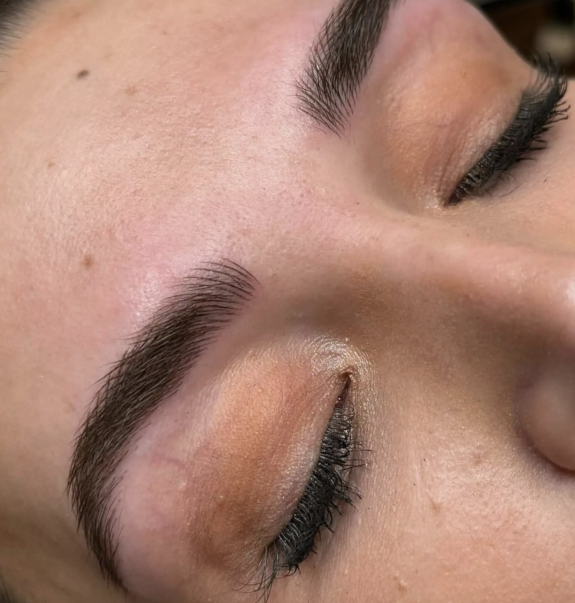 cosmetic tattoo removal sydney