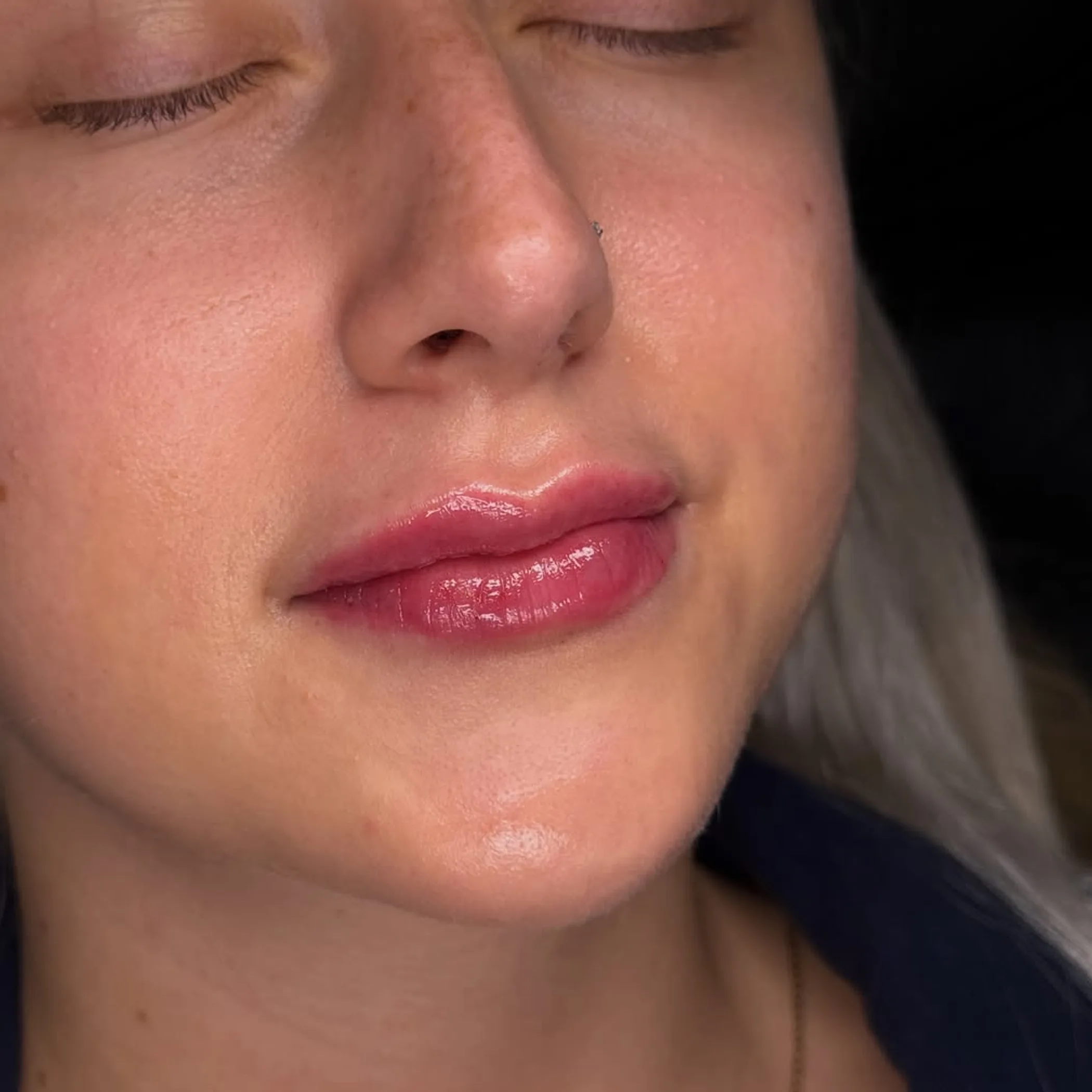 lip filler injection procedure