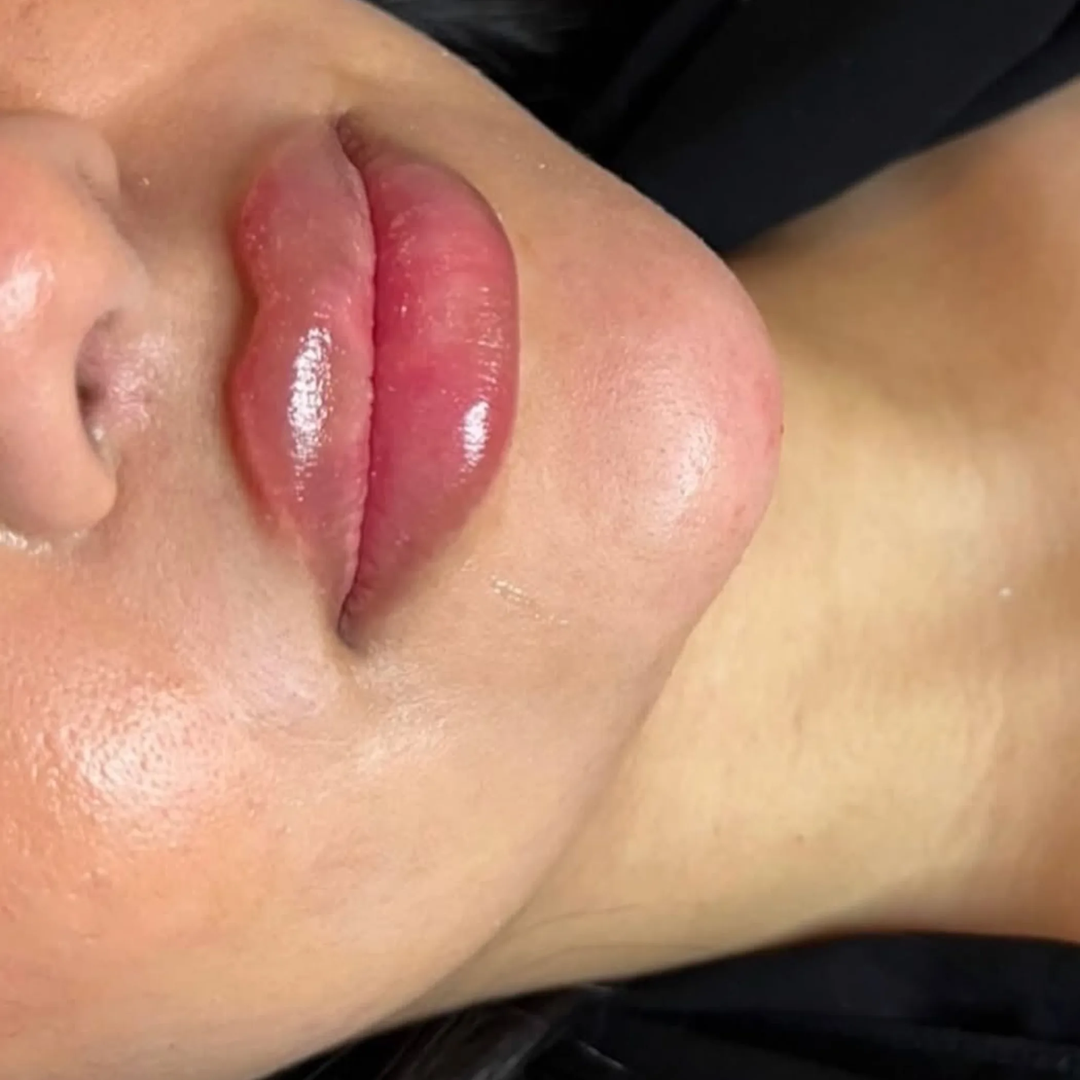 cosmetic lip filler treatment